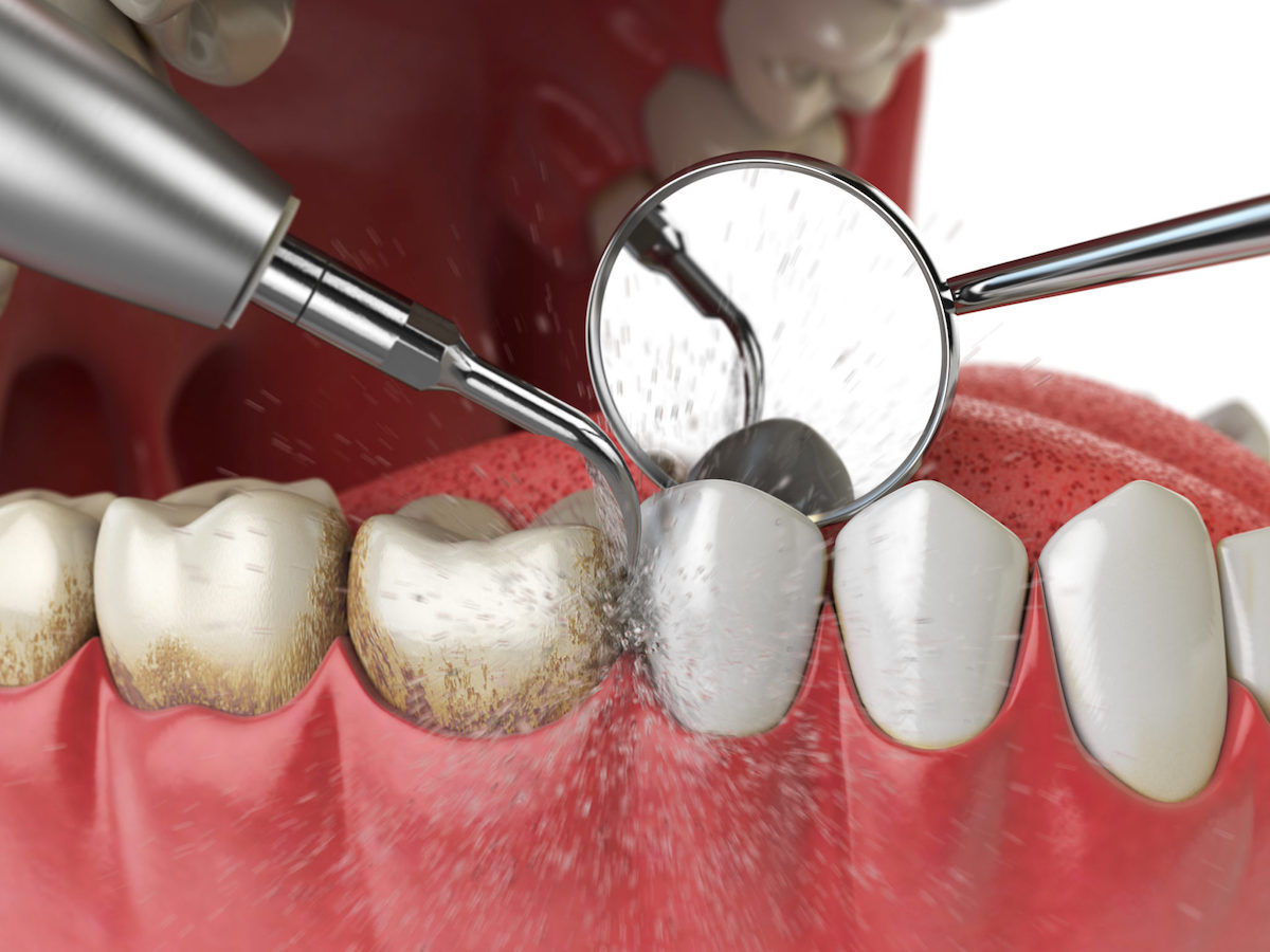 Tooth Cleaning
