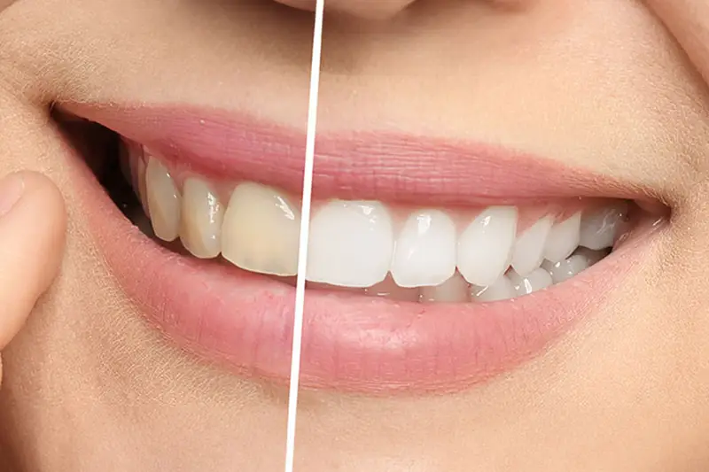 Teeth Whitening